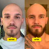 Beard Derma Roller